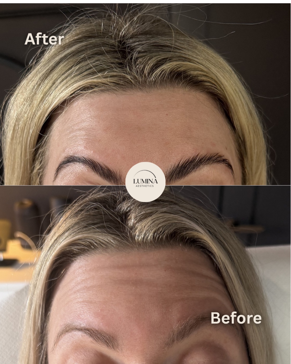 Before and after anti-wrinkle treatment at Lumina Aesthetics Limerick — natural, expressive result