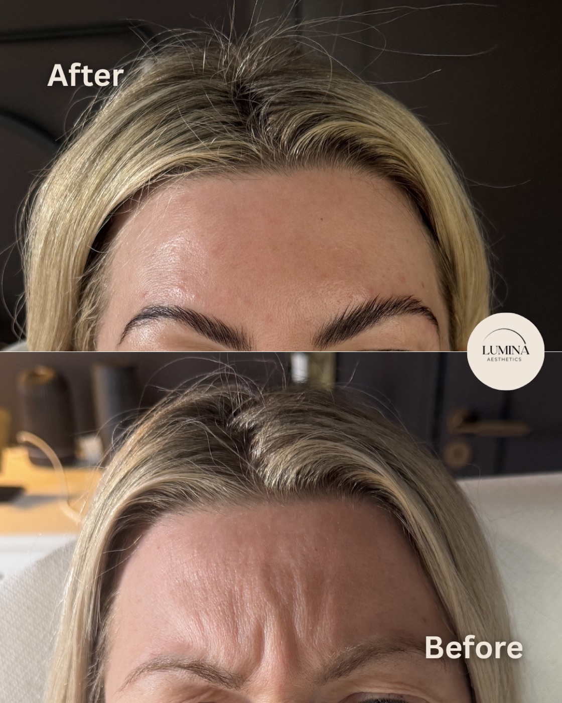 Before and after anti-wrinkle injections showing natural forehead movement retained