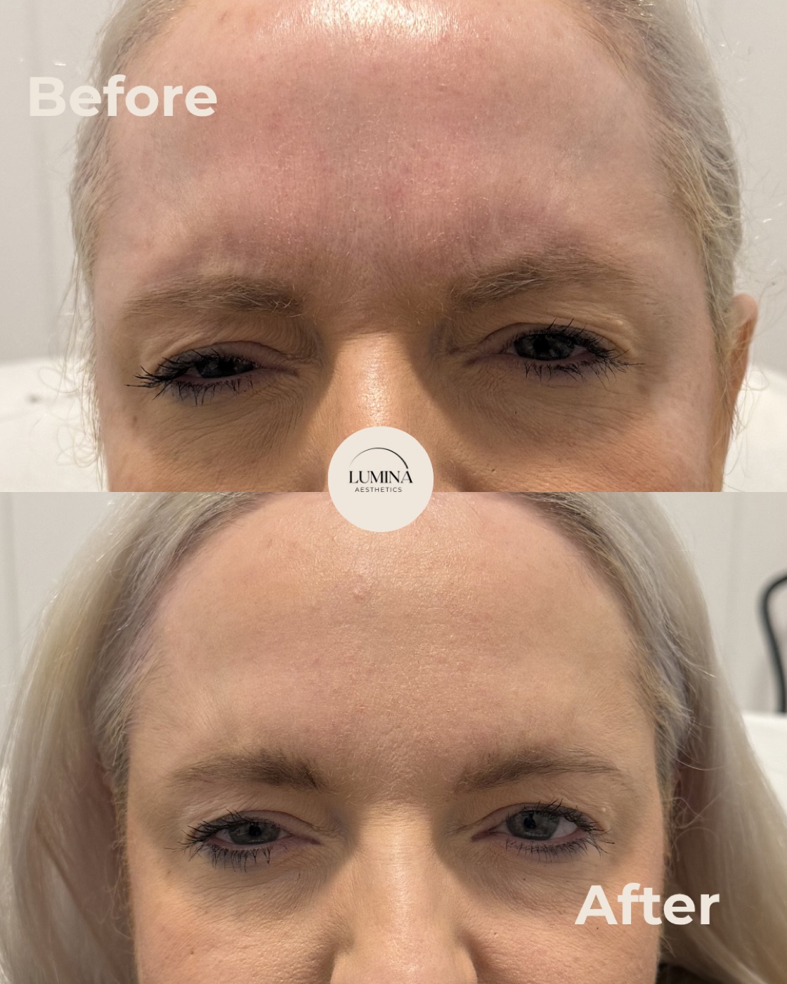 Before and after anti-wrinkle injections at Lumina Aesthetics Limerick — softened forehead lines