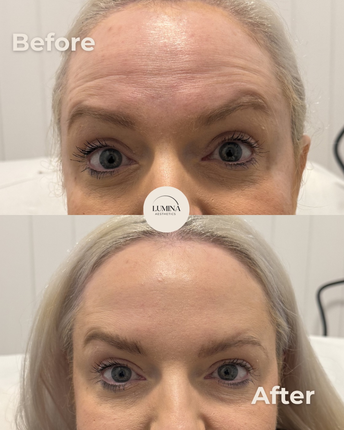 Before and after anti-wrinkle treatment around the brow and eyes at Lumina Aesthetics