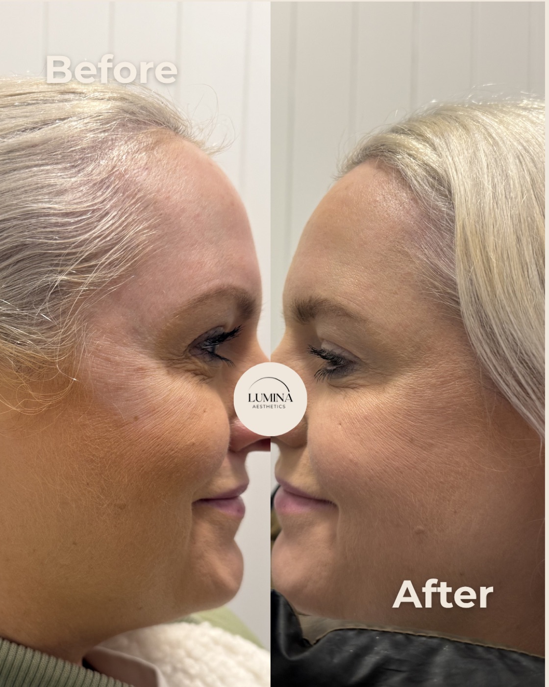 Before and after anti-wrinkle treatment, profile view, at Lumina Aesthetics Limerick