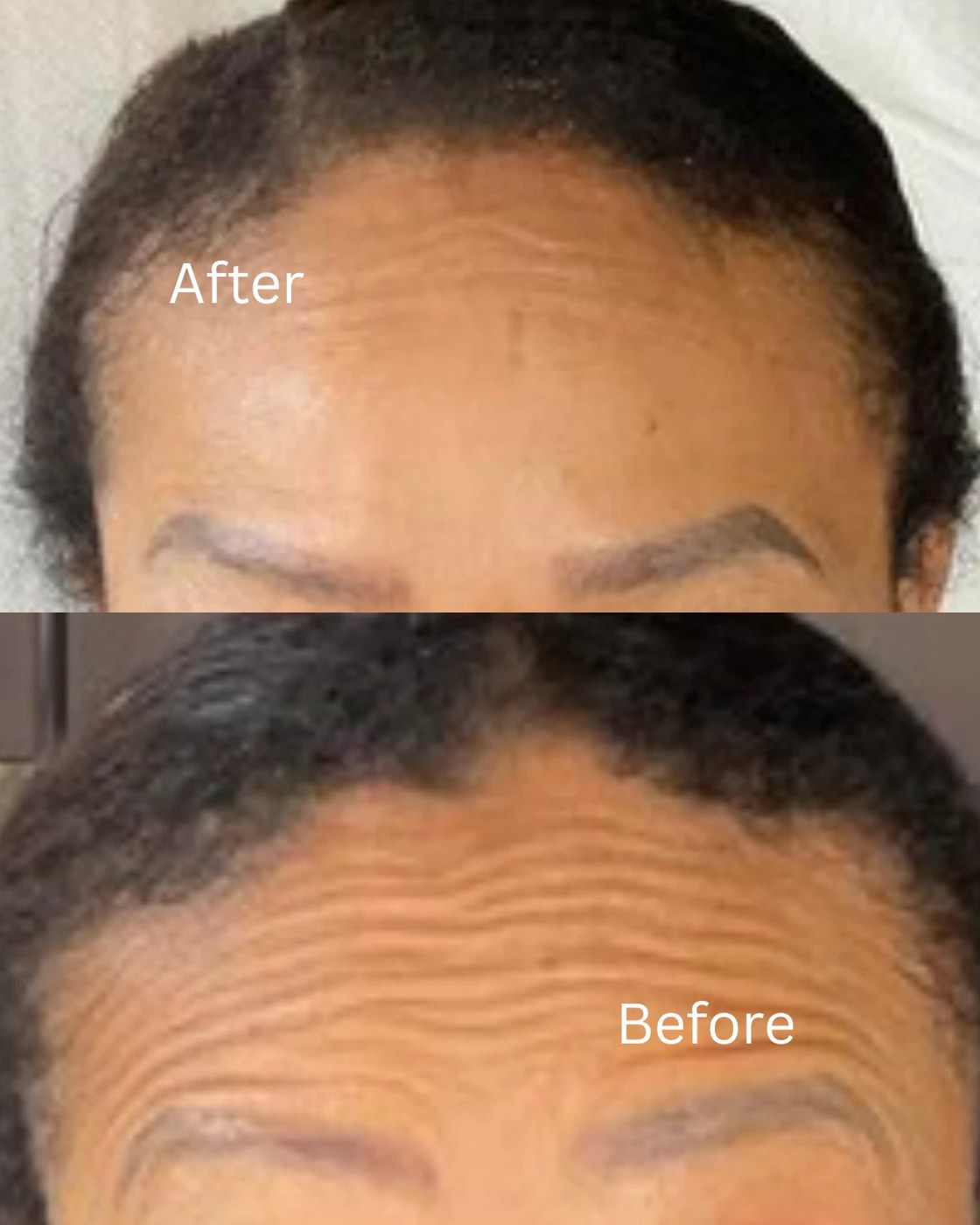 Before and after anti-wrinkle treatment at Lumina Aesthetics Limerick — deep forehead lines softened