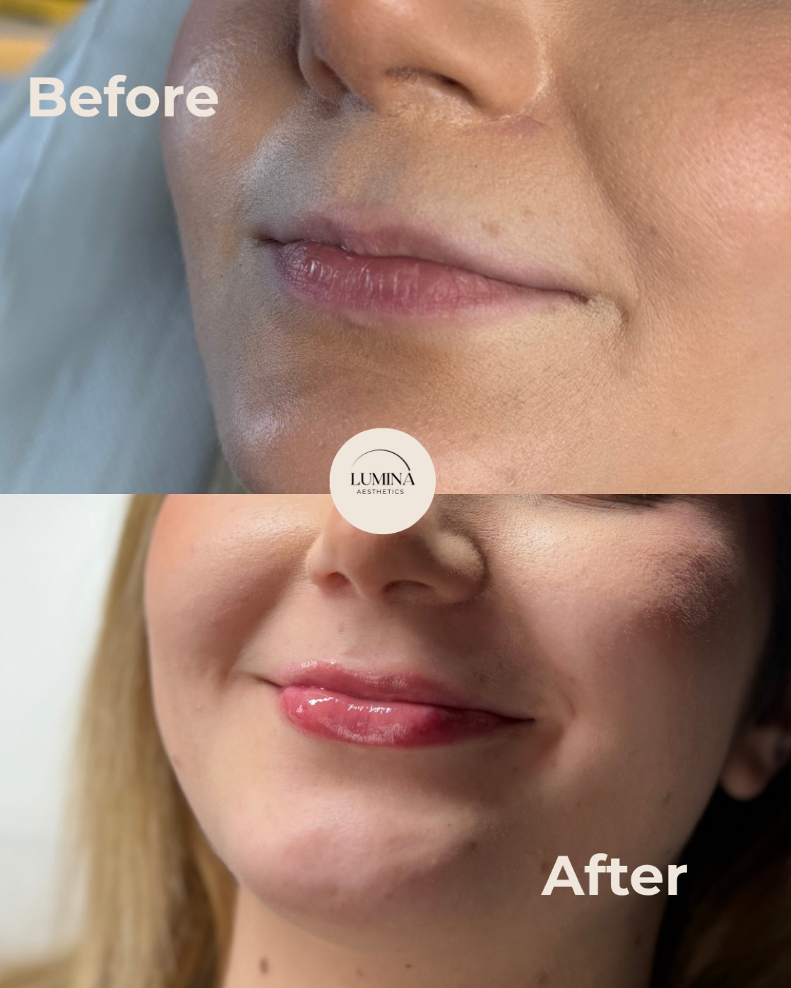 Before and after natural lip filler at Lumina Aesthetics Limerick — subtle shape and hydration