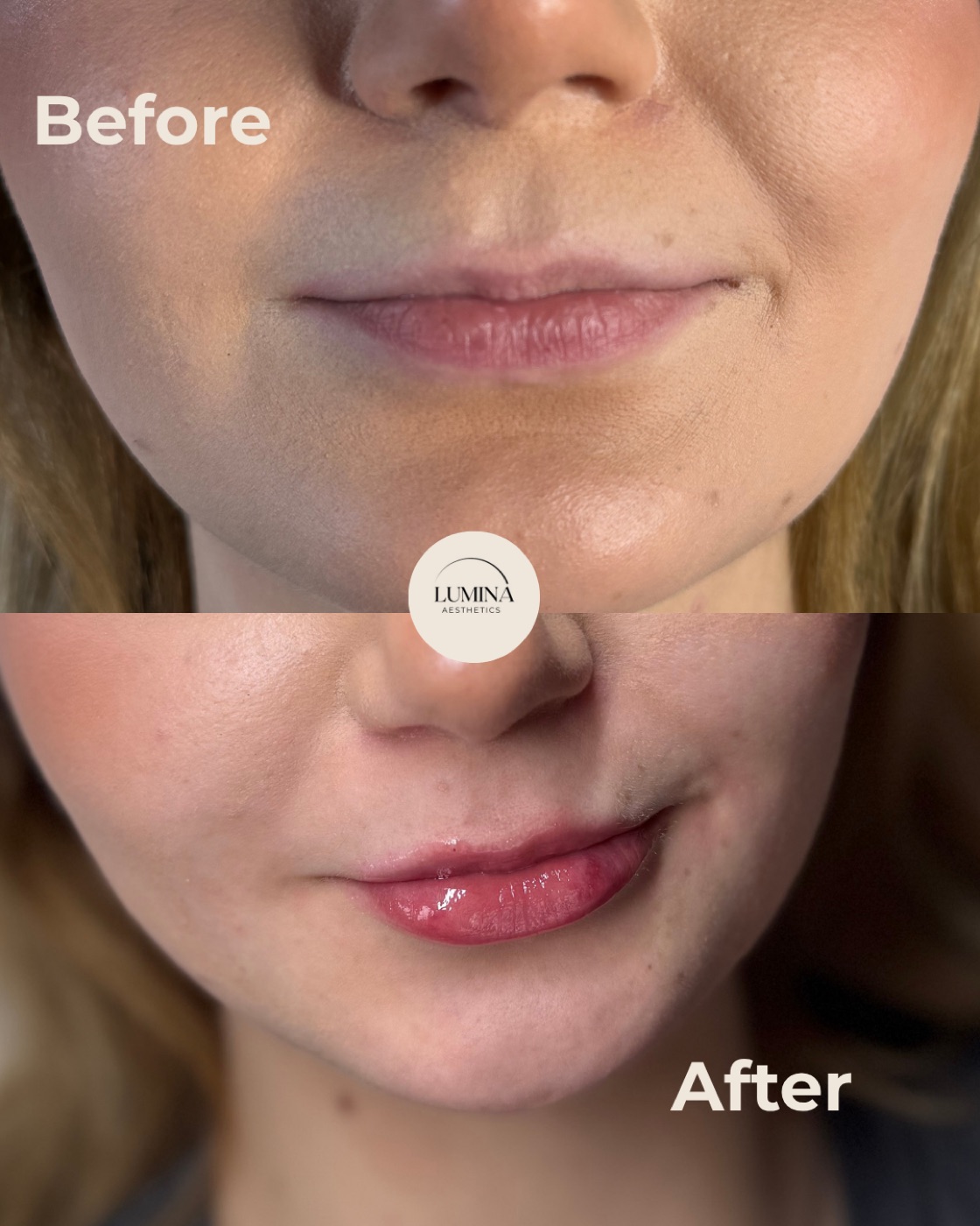 Before and after lip filler in Limerick — balanced, natural-looking lips