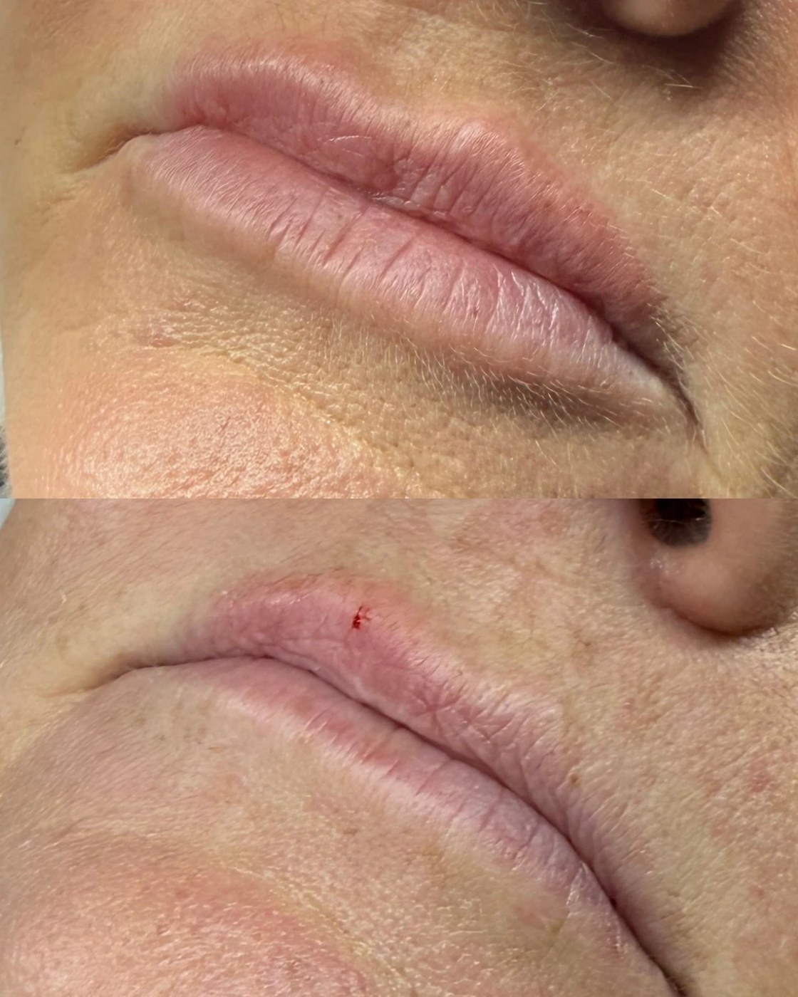 Before and after lip filler at Lumina Aesthetics Limerick — soft definition, no excess volume