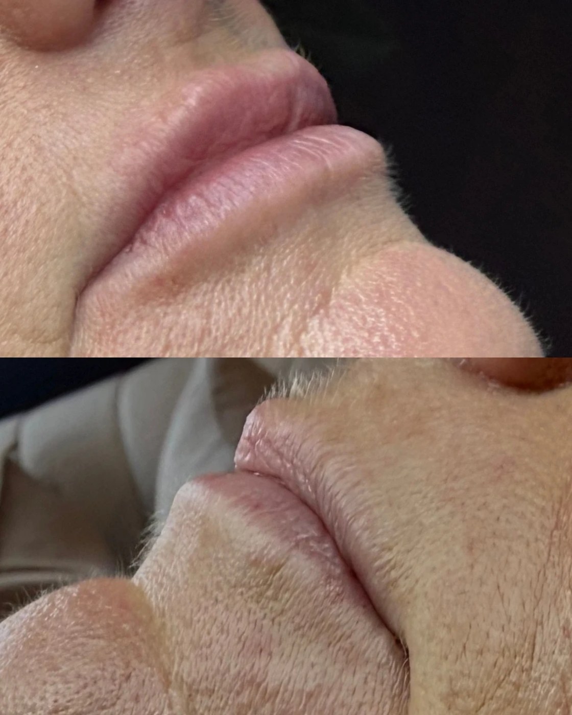 Before and after lip filler in Limerick, profile view — natural shape