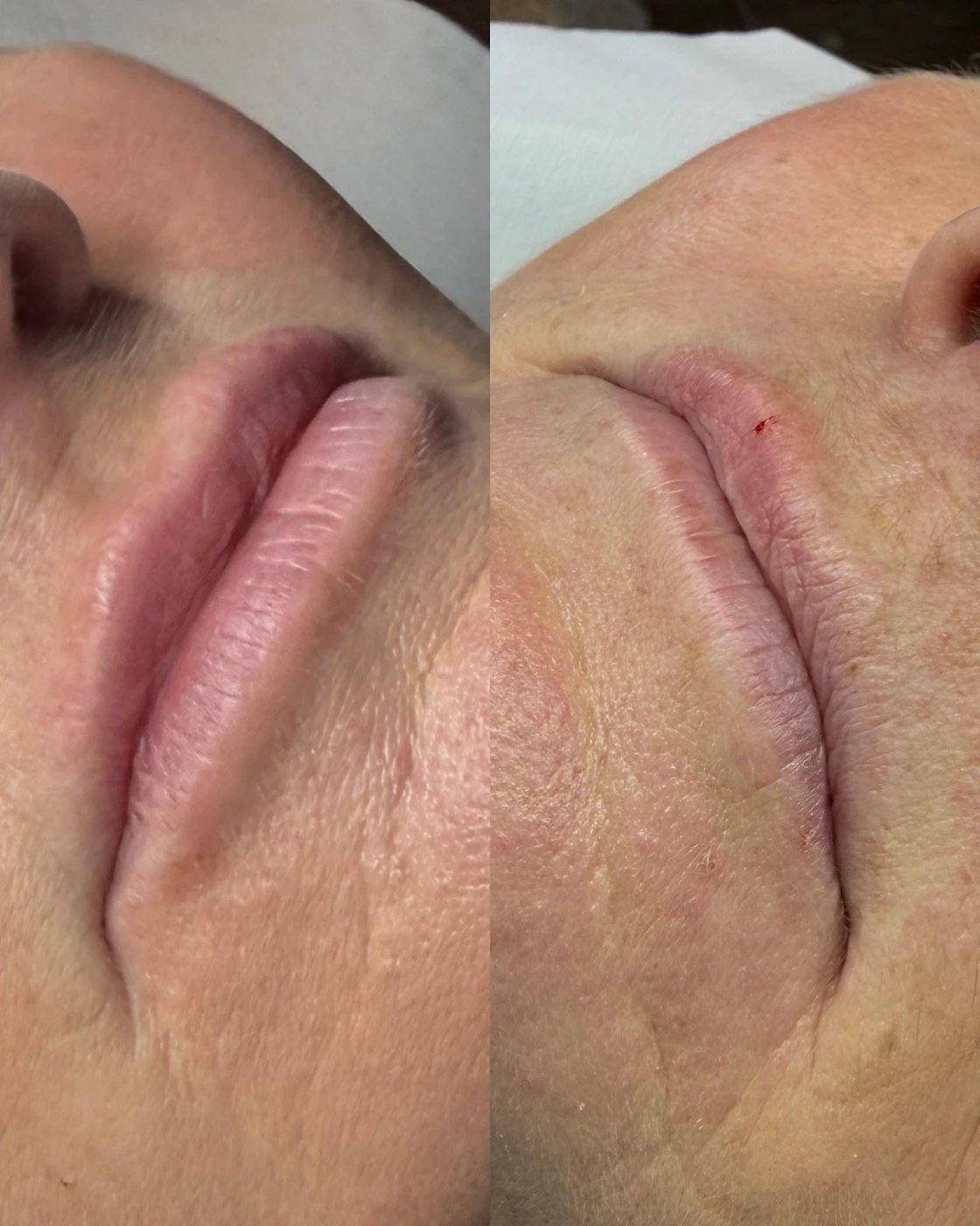 Before and after lip filler at Lumina Aesthetics Limerick — subtle, even shape