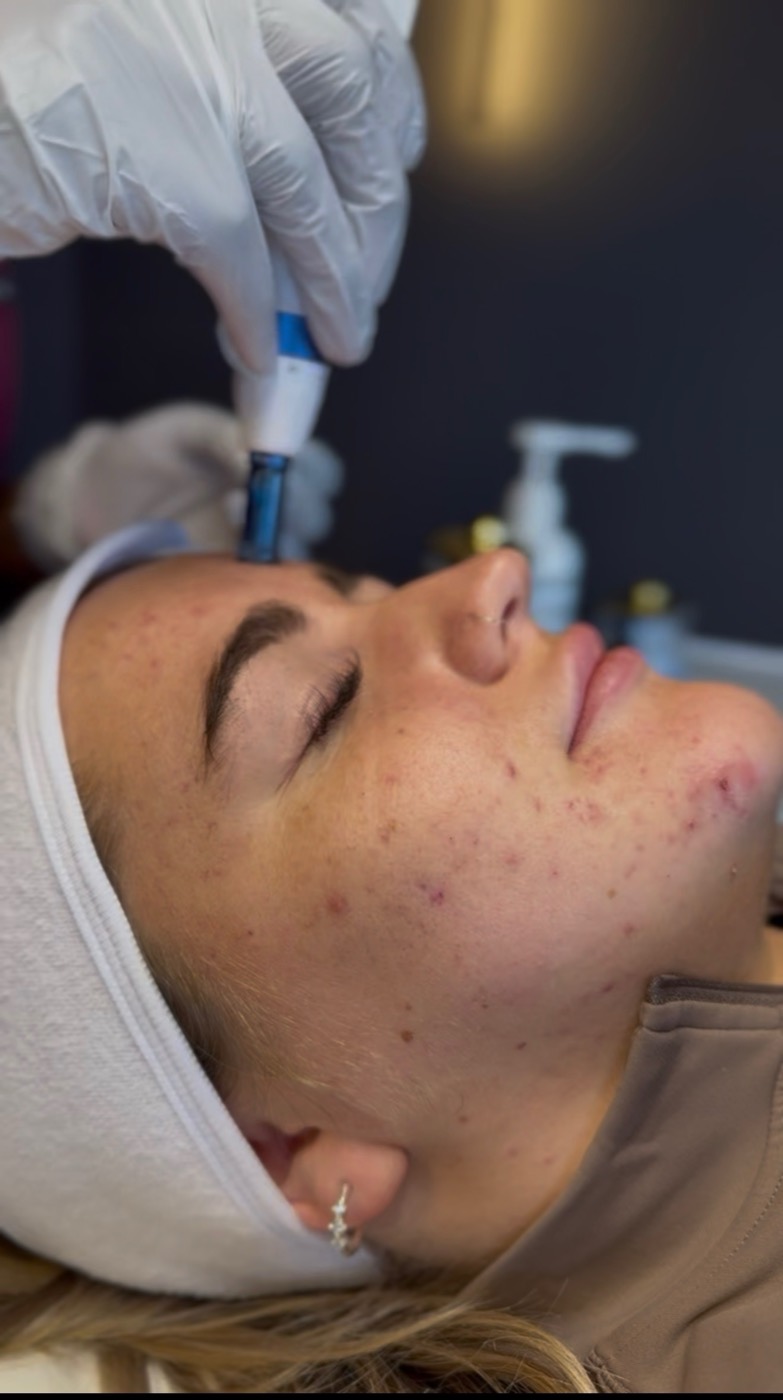 Microneedling treatment in progress at Lumina Aesthetics, Limerick