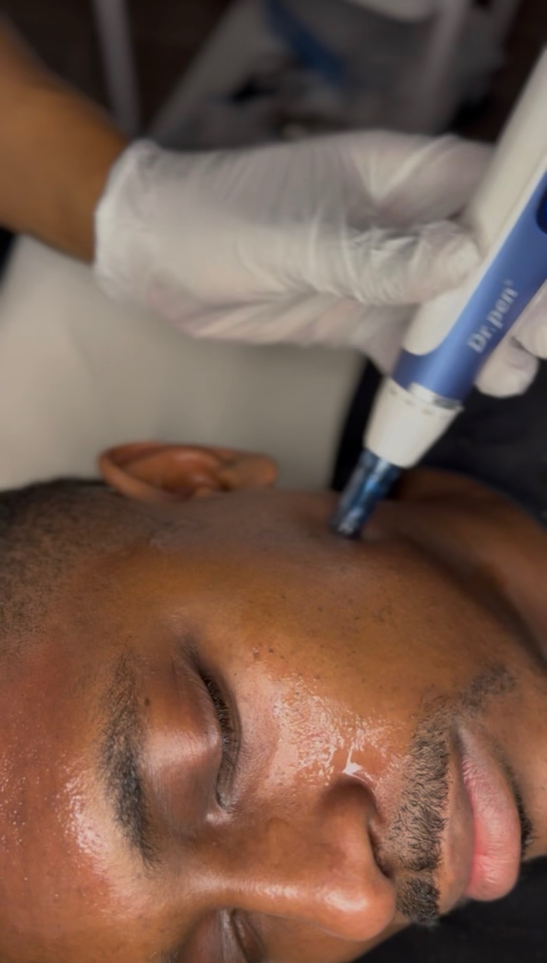 Doctor-led microneedling across the forehead at Lumina Aesthetics