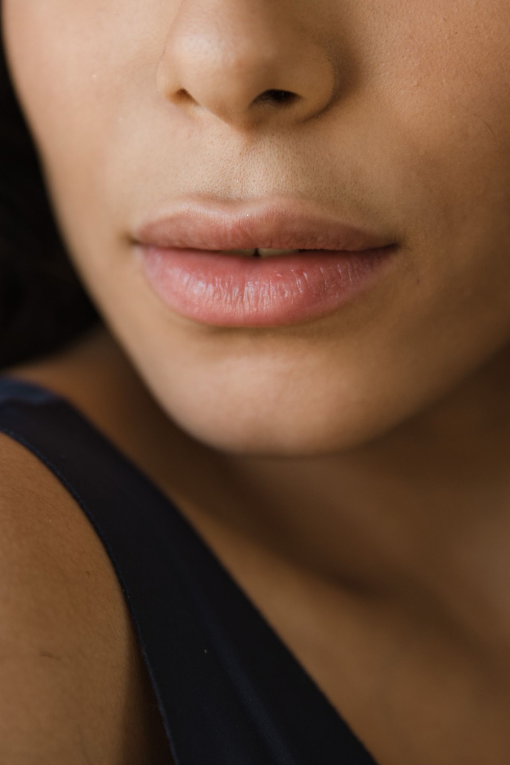 Natural-looking lips after subtle lip filler